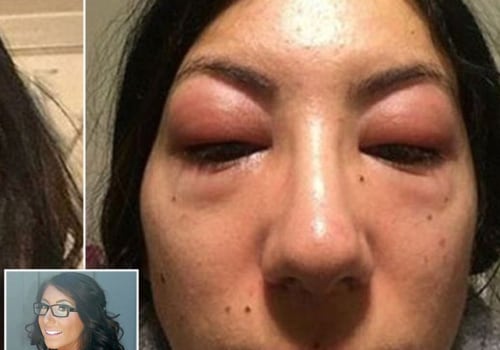 How do i stop allergic reaction to eyelash extensions?